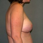 Breast Reconstruction Before & After Patient #2172