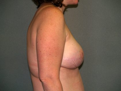 Breast Reconstruction Before & After Patient #2172