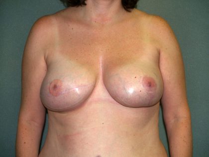 Breast Reconstruction Before & After Patient #2172