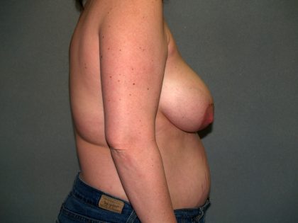 Breast Reconstruction Before & After Patient #2172