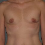 Breast Augmentation Before & After Patient #3160