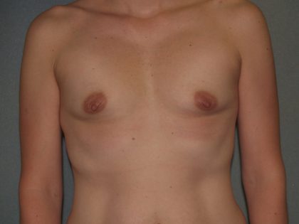 Breast Augmentation Before & After Patient #3160