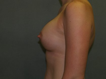 Breast Augmentation Before & After Patient #3160