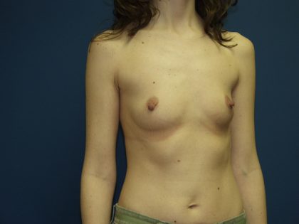Breast Augmentation Before & After Patient #3046