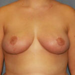 Breast Reduction Before & After Patient #3458