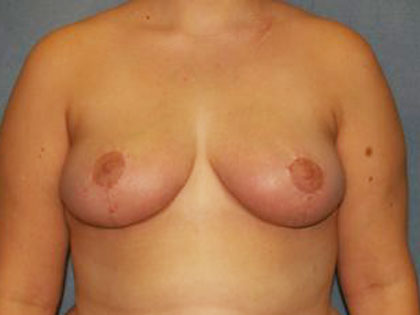 Breast Reduction Before & After Patient #3458