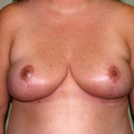Breast Reduction Before & After Patient #3284