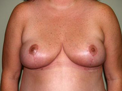 Breast Reduction Before & After Patient #3284