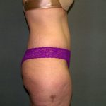 Tummy Tuck Before & After Patient #2117