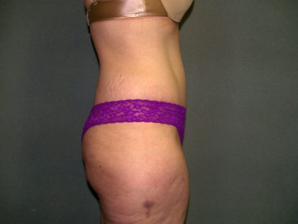 Tummy Tuck Before & After Patient #2117