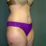 Tummy Tuck Before & After Patient #2117