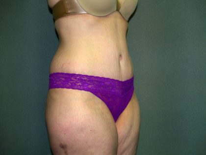 Tummy Tuck Before & After Patient #2117