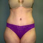 Tummy Tuck Before & After Patient #2117