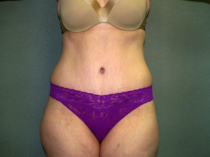 Tummy Tuck Before & After Patient #2117