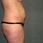 Tummy Tuck Before & After Patient #2117