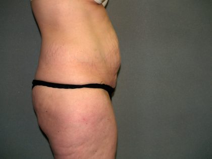 Tummy Tuck Before & After Patient #2117