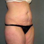 Tummy Tuck Before & After Patient #2117