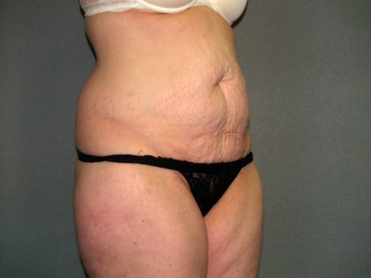 Tummy Tuck Before & After Patient #2117