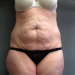 Tummy Tuck Before & After Patient #2117