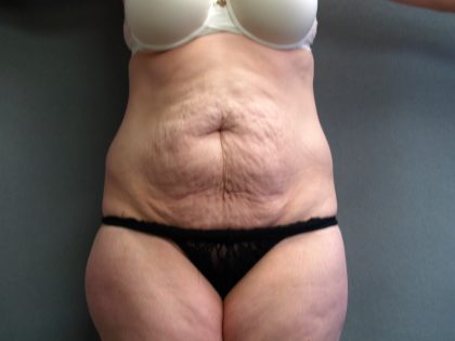 Tummy Tuck Before & After Patient #2117