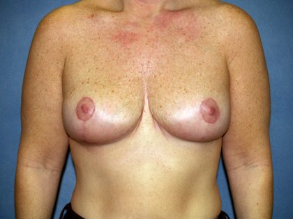 Breast Lift Before & After Patient #1638