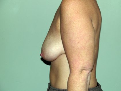 Breast Lift Before & After Patient #1638