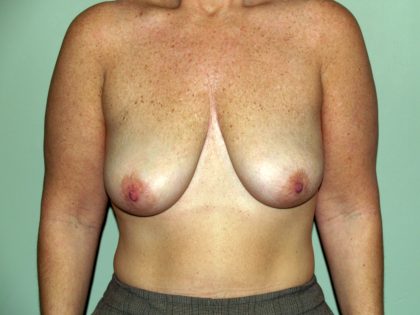 Breast Lift Before & After Patient #1638