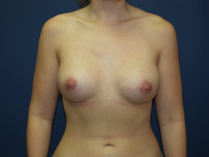 Breast Augmentation Before & After Patient #1617