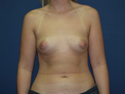 Breast Augmentation Before & After Patient #1617