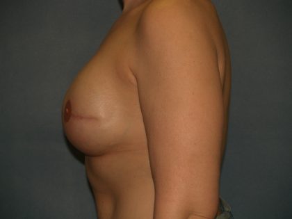 Breast Reconstruction Before & After Patient #1948