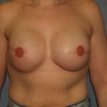 Breast Reconstruction Before & After Patient #1948