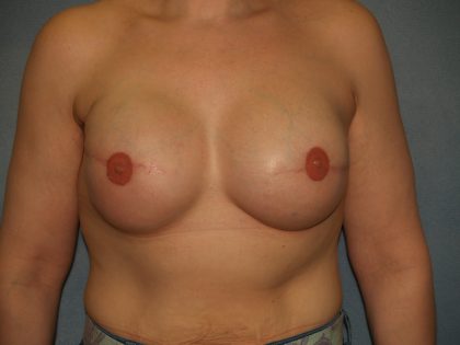 Breast Reconstruction Before & After Patient #1948