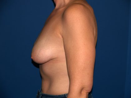 Breast Reconstruction Before & After Patient #1948