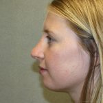 Nose Surgery Before & After Patient #797