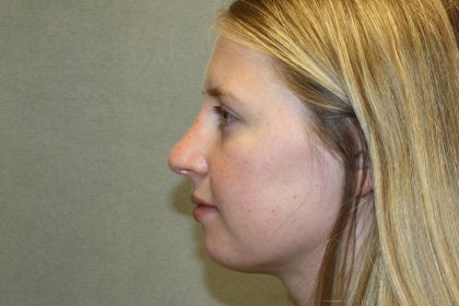 Nose Surgery Before & After Patient #797