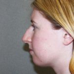 Nose Surgery Before & After Patient #797