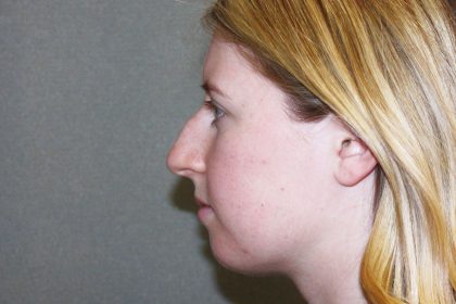 Nose Surgery Before & After Patient #797