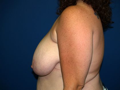 Breast Reduction Before & After Patient #3284