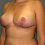 Breast Reduction Before & After Patient #3415