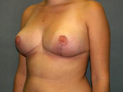 Breast Reduction Before & After Patient #3415