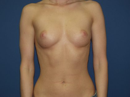Breast Augmentation Before & After Patient #2605