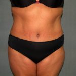 Tummy Tuck Before & After Patient #2389