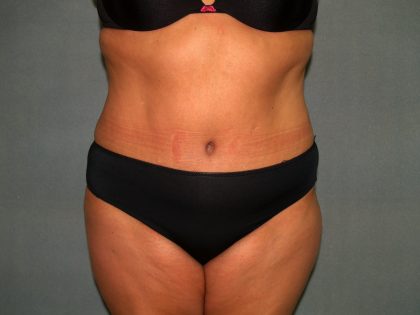 Tummy Tuck Before & After Patient #2389