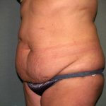 Tummy Tuck Before & After Patient #2389