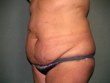 Tummy Tuck Before & After Patient #2389