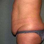 Tummy Tuck Before & After Patient #2389