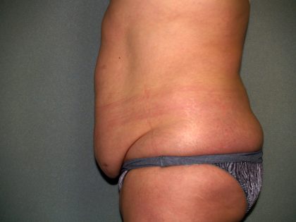 Tummy Tuck Before & After Patient #2389