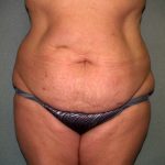 Tummy Tuck Before & After Patient #2389