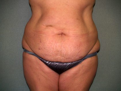 Tummy Tuck Before & After Patient #2389