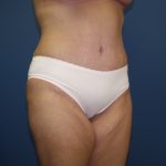 Tummy Tuck Before & After Patient #2251